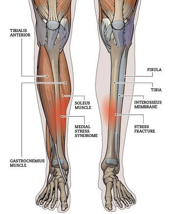 anatomy of shin splints-image