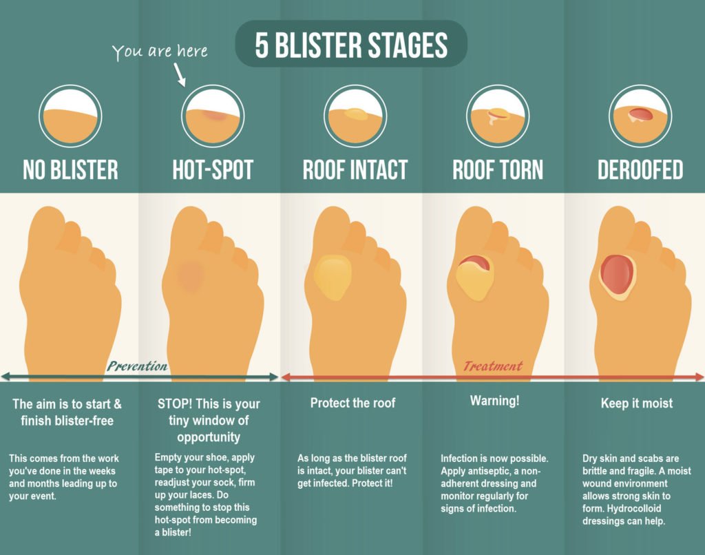 Blister Stages