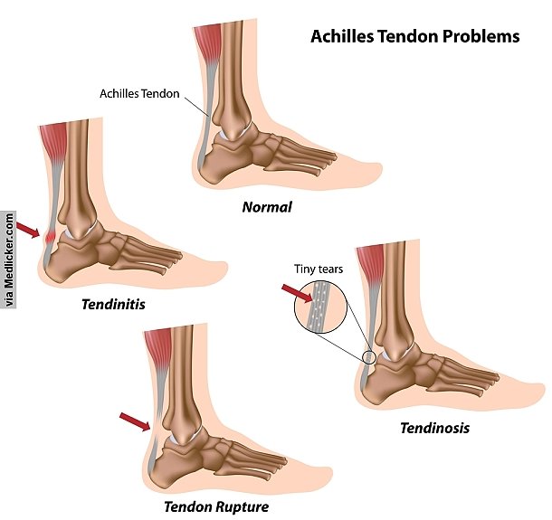 achilles-tendon-problems-image